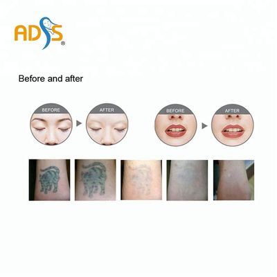 เครื่องเลเซอร์ ND YAG ฟื้นฟูผิว Q เปลี่ยนเครื่องเลเซอร์ลอกผิวคาร์บอน 1064 นาโนเมตร