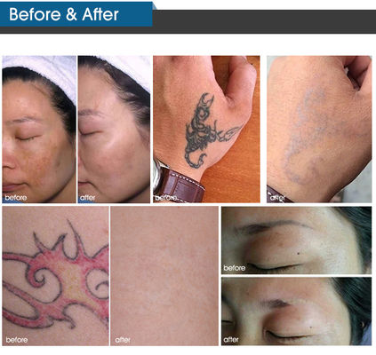 เครื่องเลเซอร์กำจัดเม็ดสี Picosecond ความงามในแนวตั้ง